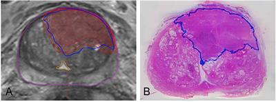 Isotropic Expansion of the Intraprostatic Gross Tumor Volume of Primary Prostate Cancer Patients Defined in MRI—A Correlation Study With Whole Mount Histopathological Information as Reference